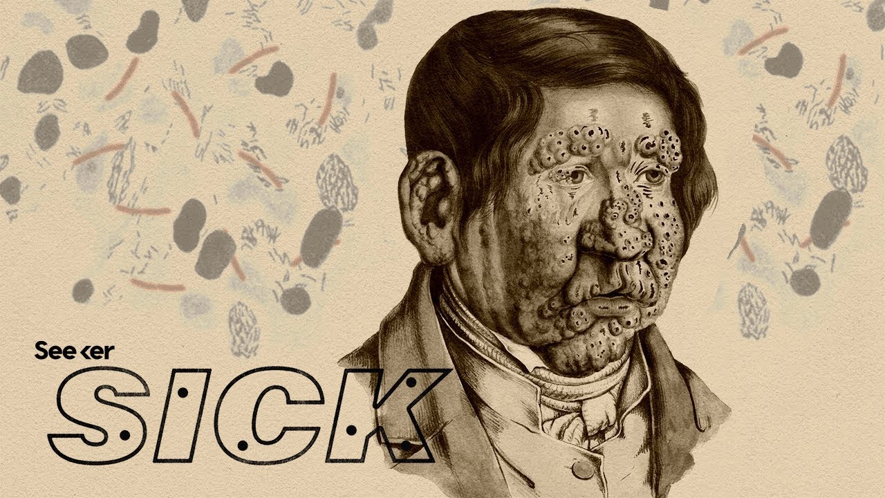 How Leprosy Affects the Human Body 🦠