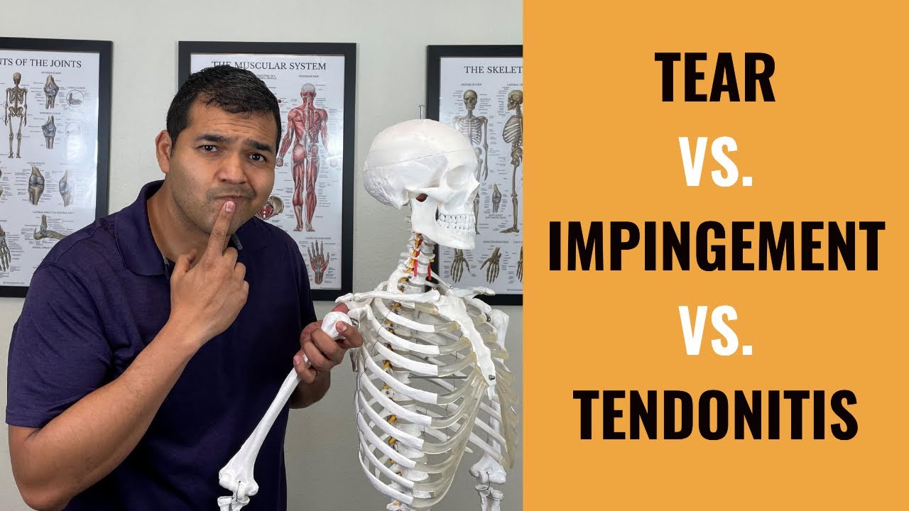 Rotator Cuff Tear, Impingement & Tendonitis Explained