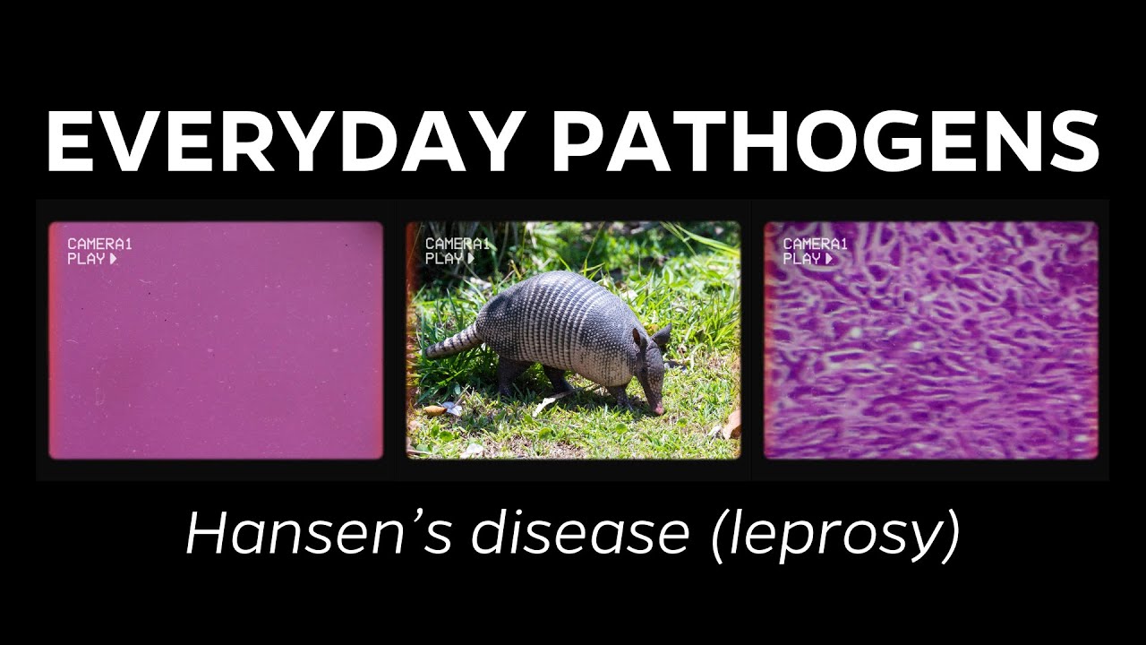 What Is Leprosy (Hansen's Disease)?