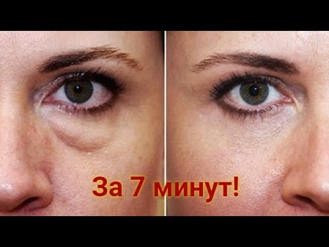 Как быстро избавиться от мешков и отеков под глазами 👁️