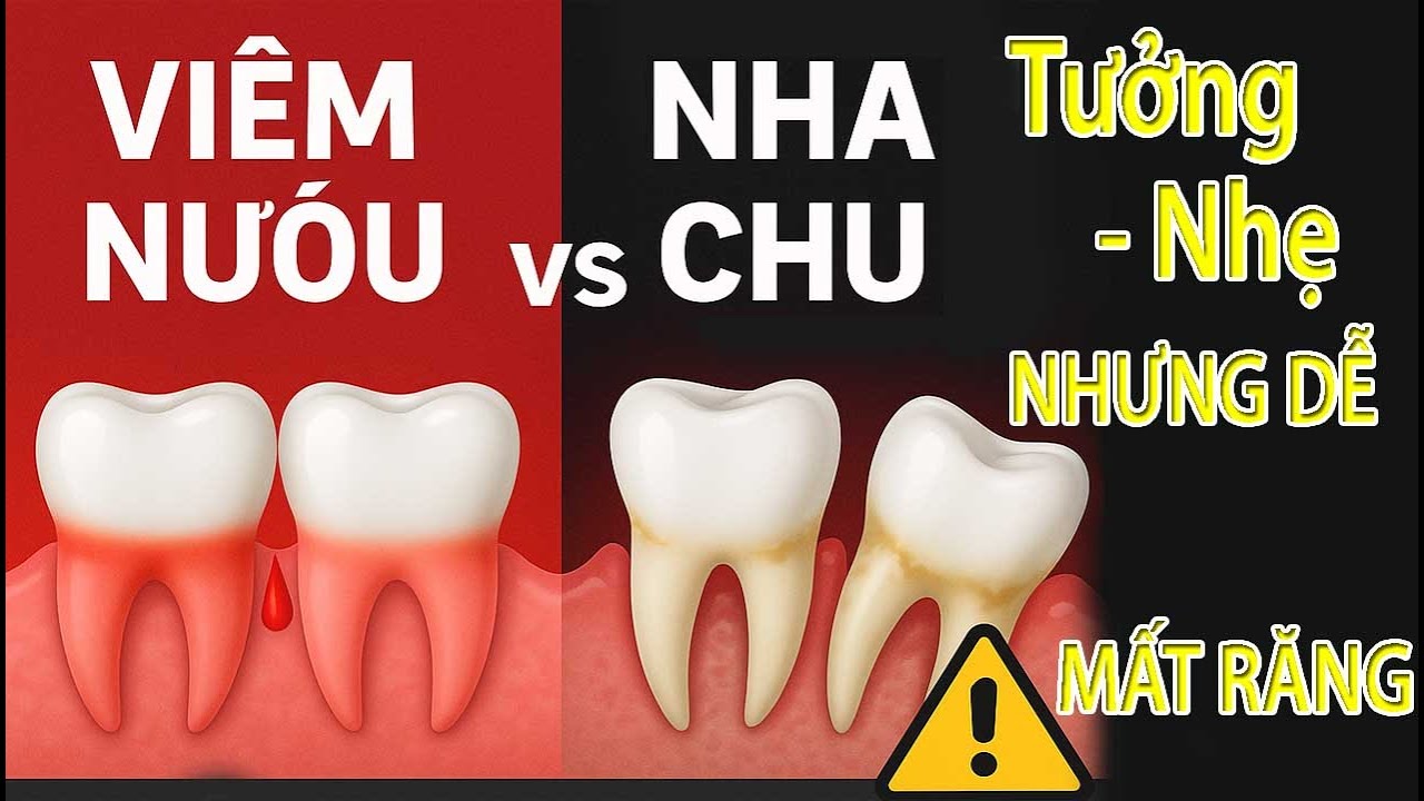 Viêm Nướu & Nha Chu: Khác Biệt & Nguy Hiểm 🦷
