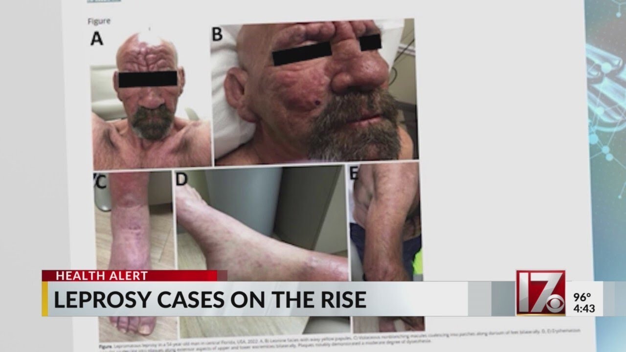 Leprosy Cases Increasing in the U.S. 🦠