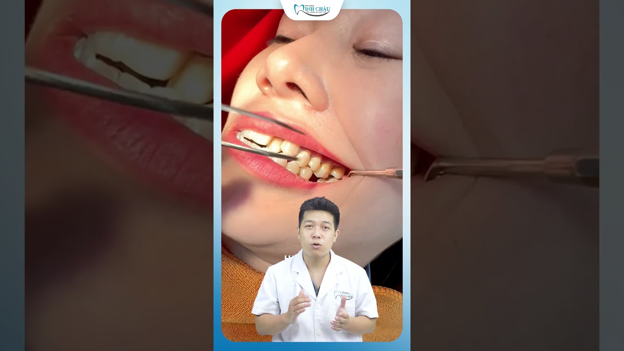 Mất Răng Bao Lâu Thì Nên Trồng? 🦷