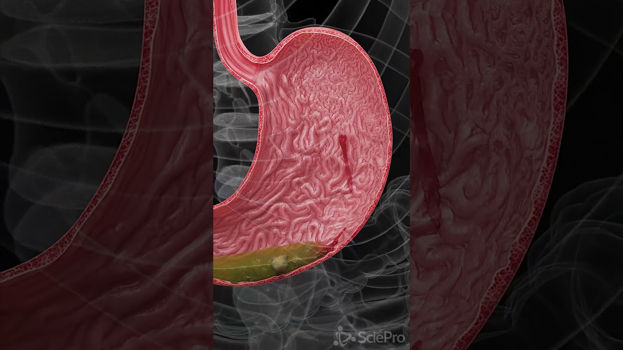 Hemorrhagic Gastric Ulcers Explained: Symptoms, Causes & 3D Anatomy 🩺