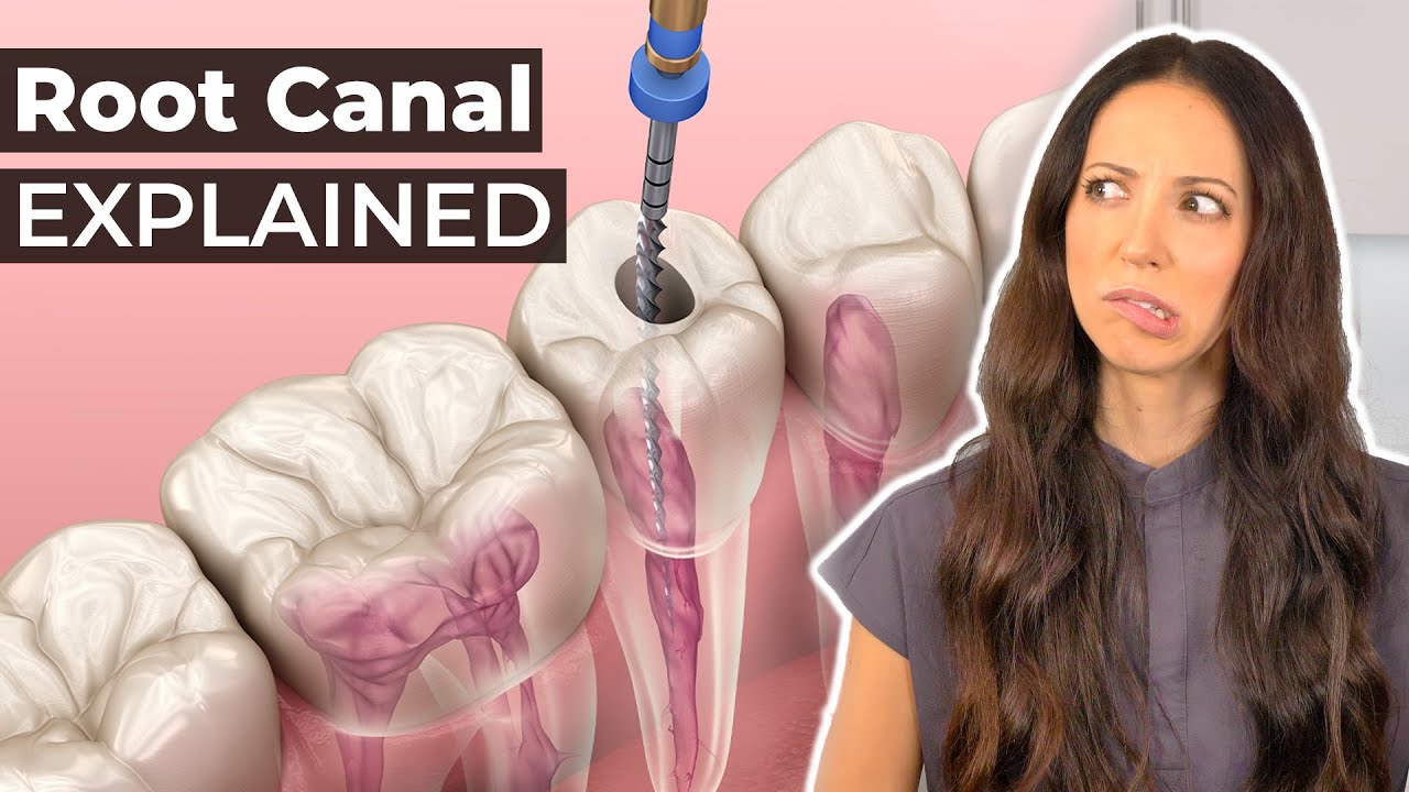 Root Canal: Do You Need One? 🦷