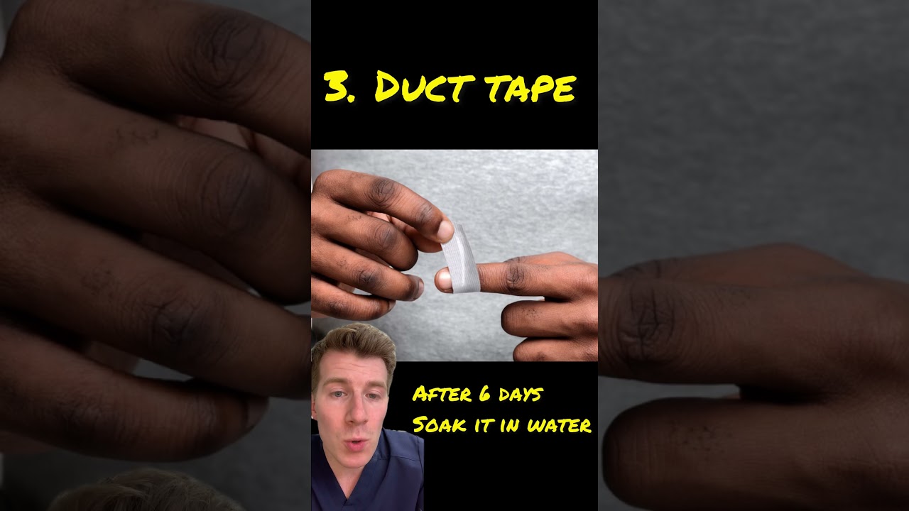 Home Remedies for Warts in 60 Seconds ⏱️