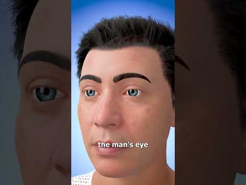 How Eye Transplants Work 👁️