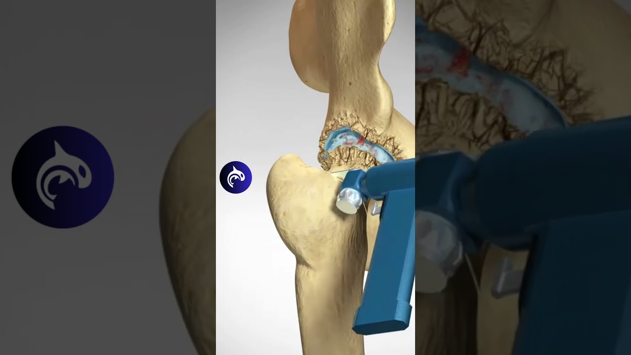 Watch the Complete Hip Replacement Surgery in Stunning 3D 🦾