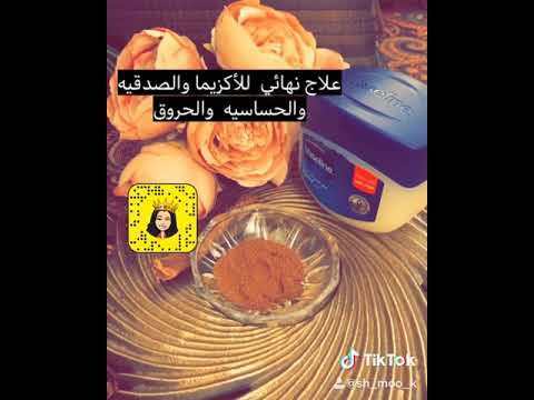 علاج نهائي للأكزيما والصدفيه والحساسيه بكريم القسط الهندي رائع جربوه وادعولي