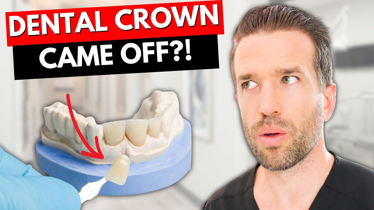 Dental Crown Fell Off? Here's What to Do 🦷