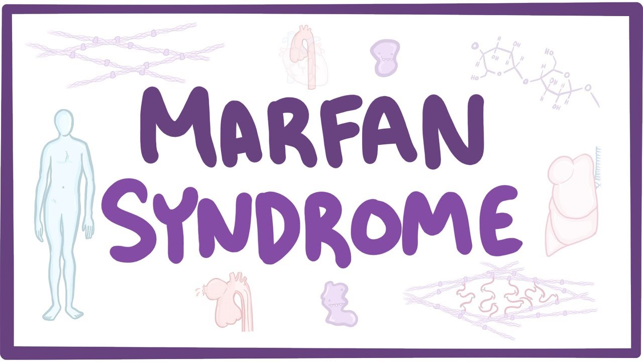 Understanding Marfan Syndrome: Causes, Symptoms, Diagnosis, Treatment, and Pathology
