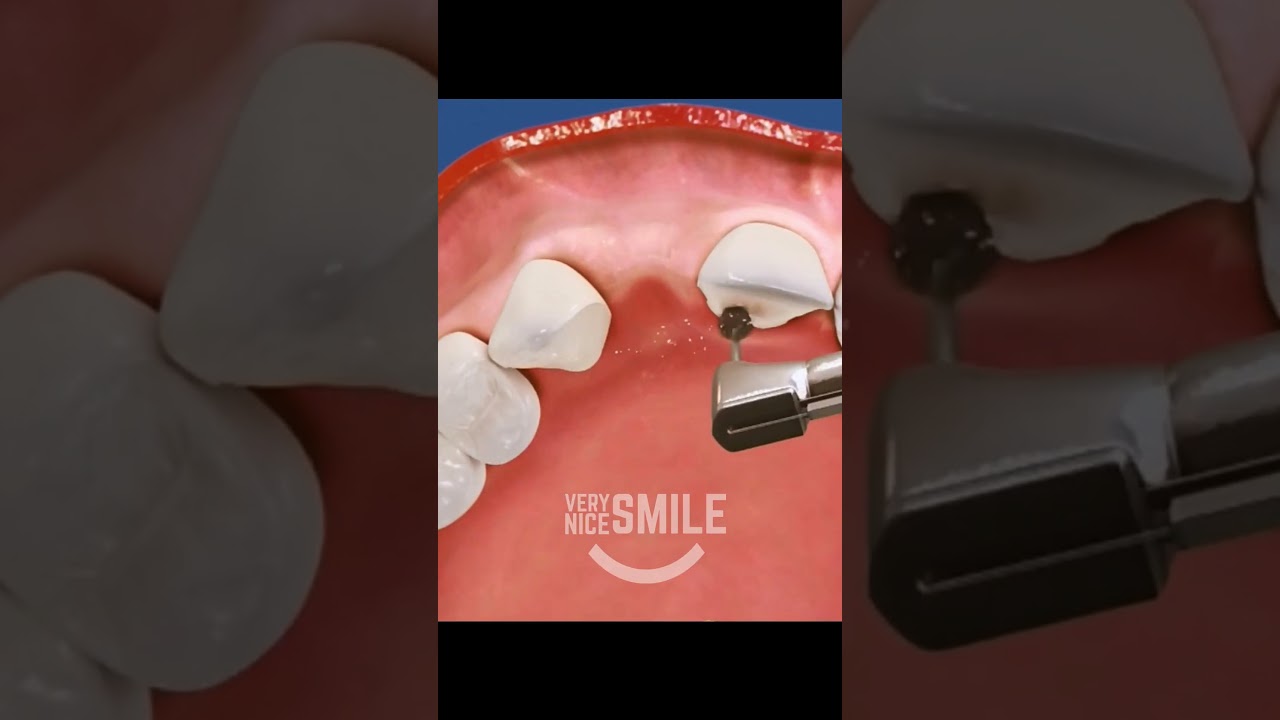 Maryland Dental Bridge: Affordable Tooth Replacement