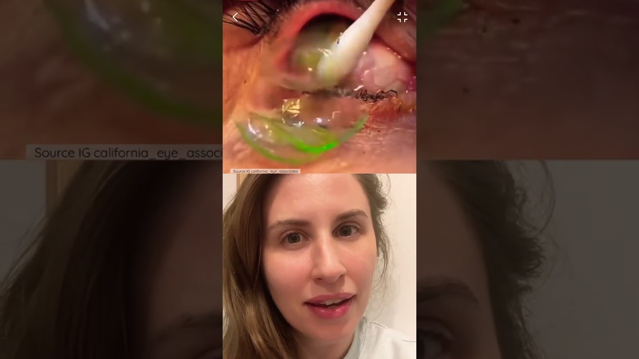 Doctor Removes Massive Number of Contact Lenses 👁️
