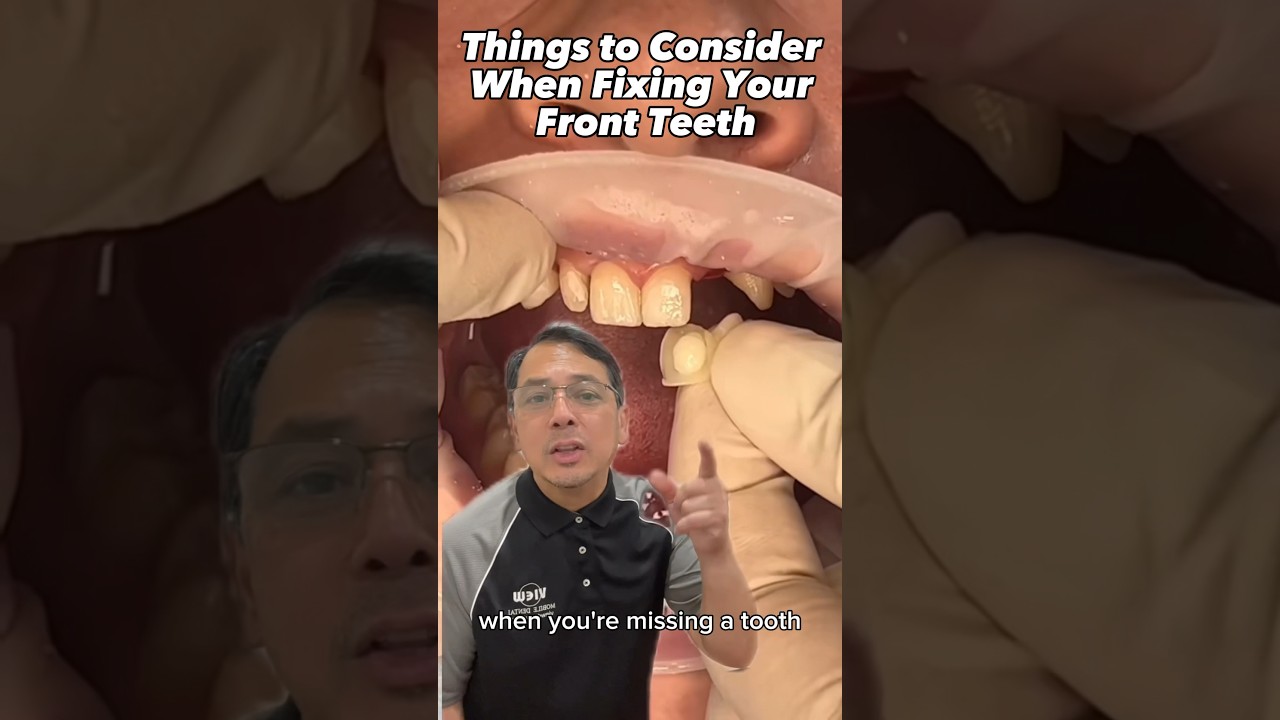 Anterior Teeth Repair: Fixed Bridge & Bonding 🦷