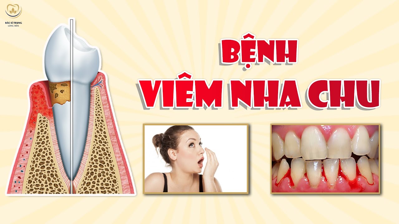Viêm Nha Chu & Nướu: Nguyên nhân & Điều trị 🦷