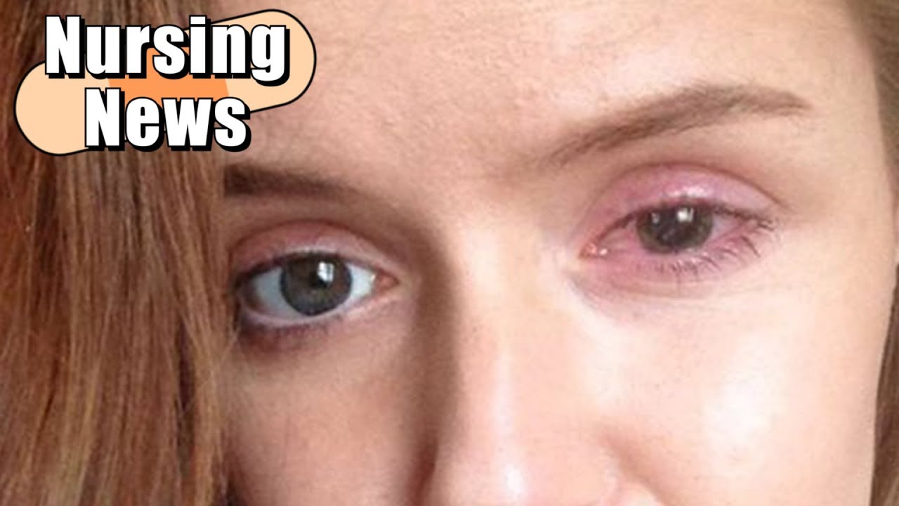 Contact Lens Stuck in Eye for 30 Years ποΈ