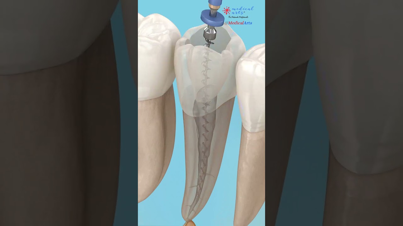 Inside a Root Canal Procedure π¦·