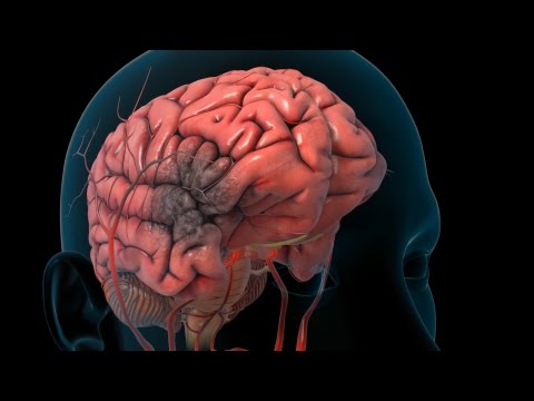 Stroke Overview | Nucleus Health