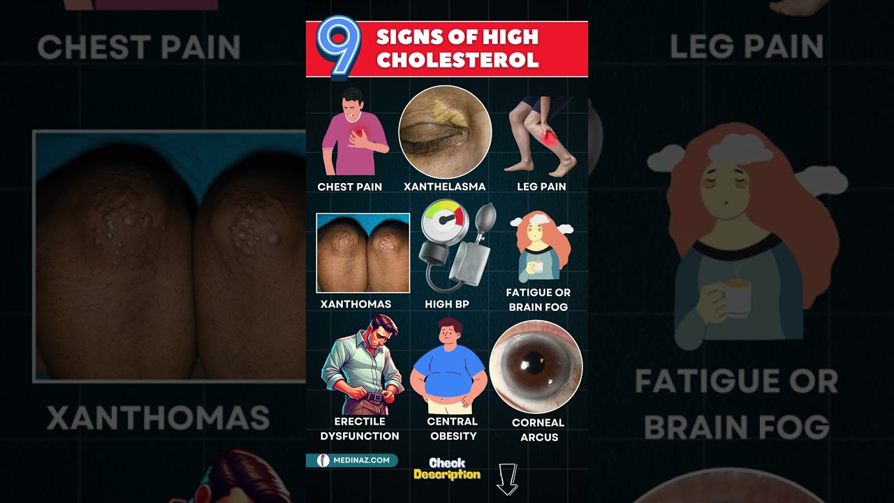 High Cholesterol Symptoms & Signs 🚩