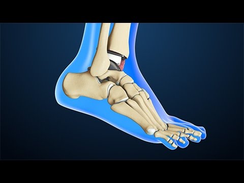 Total Ankle Replacement Surgery Overview 🦶