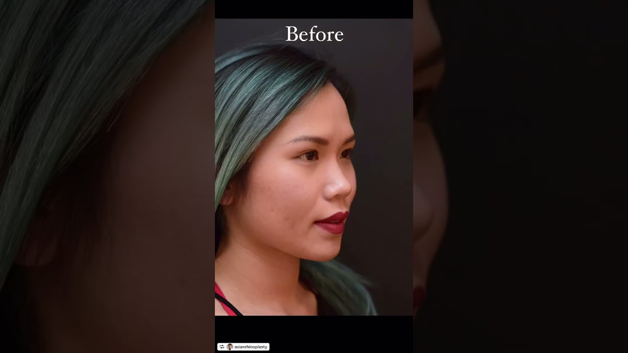 Asian Double Eyelid Surgery by Dr. Yoo ✨