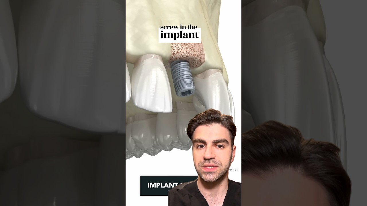 Tooth Implant Procedure: Step-by-Step Guide 🦷