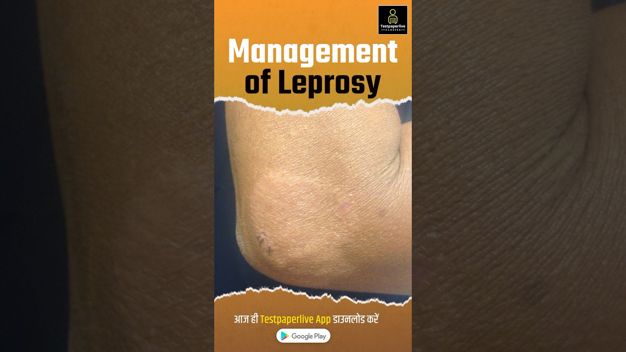 Leprosy Management: Treatment & Prevention 🩺