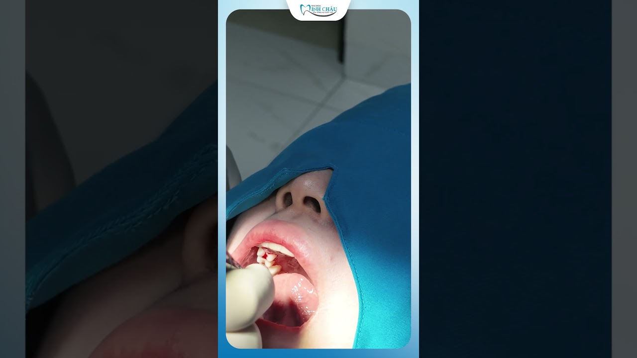 Chữa Cao Răng & Viêm Lợi tại Nha Khoa Minh Châu