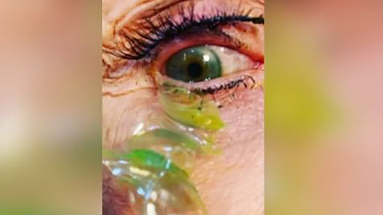Doctor Extracts 23 Contact Lenses from Patient's Eye