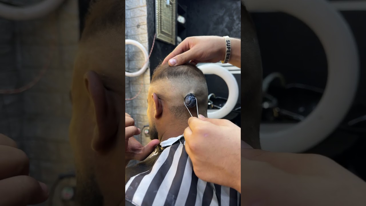 إزالة الحبة المتسلطة باليد بسهولة ✂️