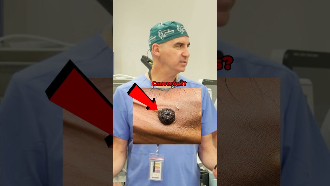 Check Your Moles for Skin Cancer 🩺