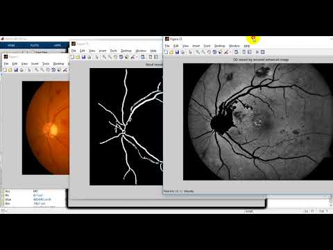 Automatic Detection of Retinal Lesions for Screening of Diabetic Retinopathy|ieee 2019 projects