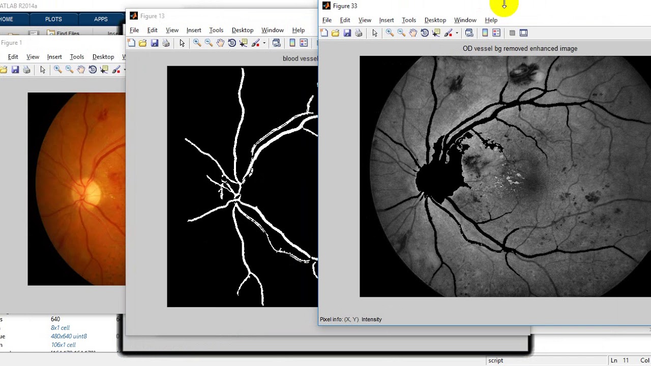 Automated Retinal Lesion Detection for Diabetic Retinopathy Screening | IEEE 2019 Projects
