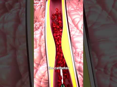 How Heart Stents Work 🤔