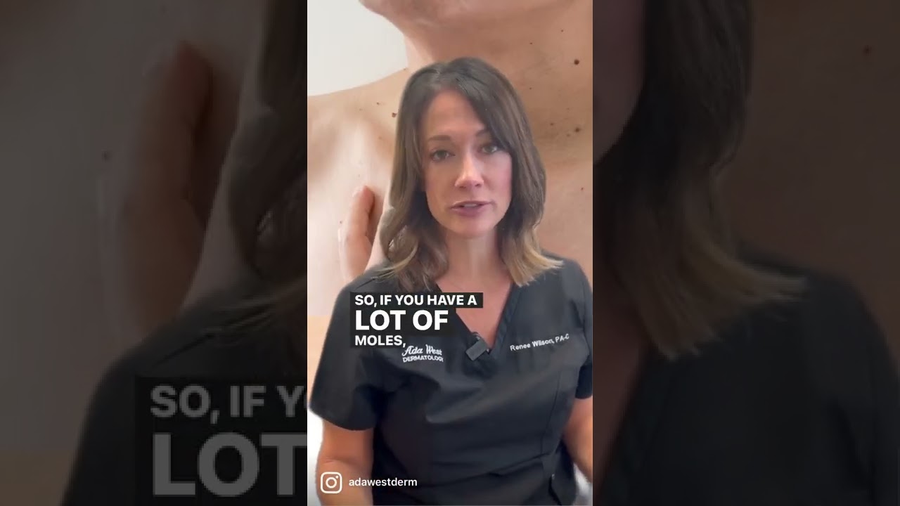 Moles & Skin Cancer Risk: What to Watch For 🩺