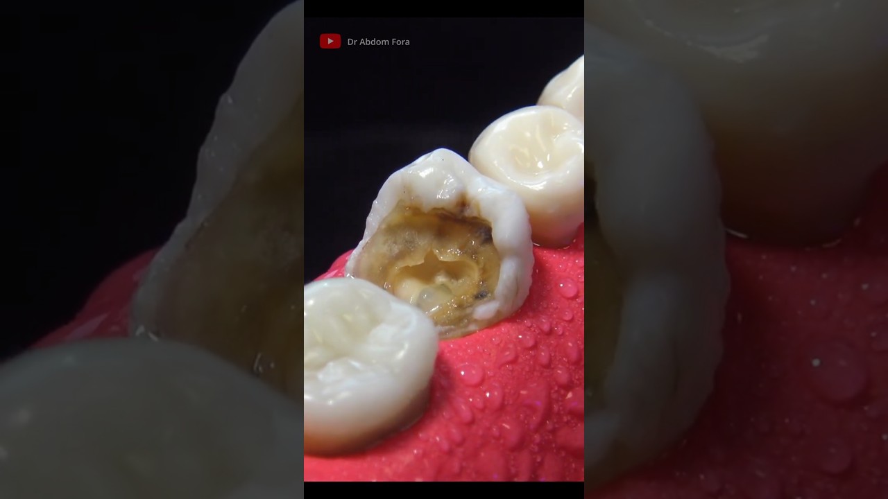 Amazing Root Canal & Restoration 🦷