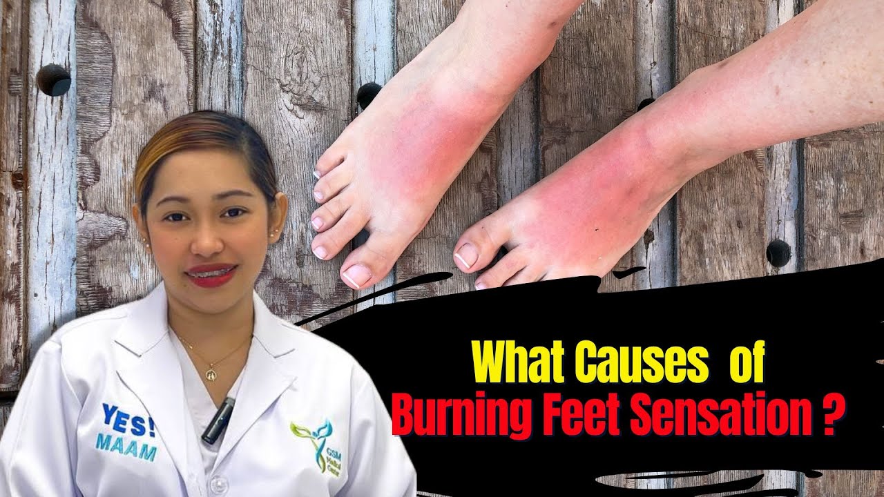 Understanding and Treating Burning Feet Syndrome: Proven Remedies for Relief 🔥