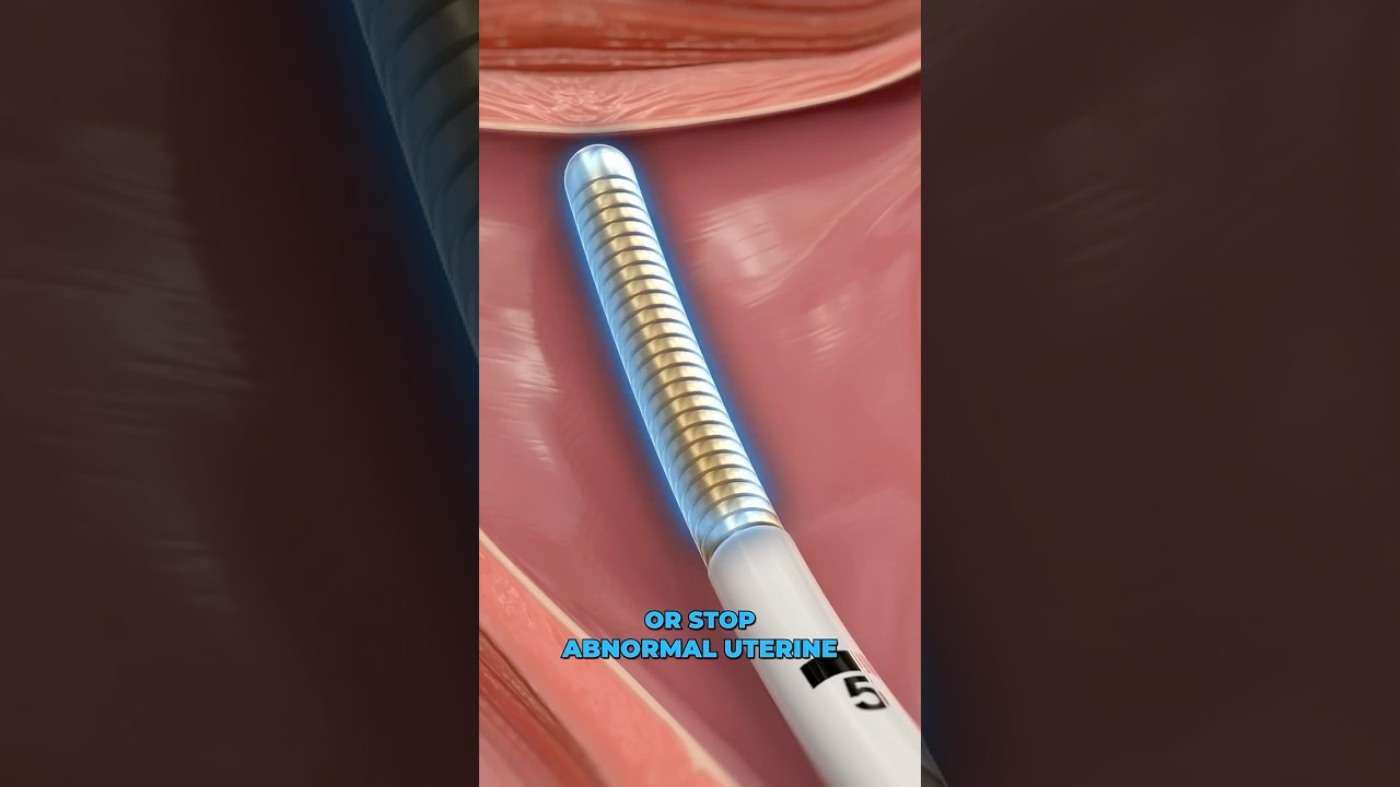 Endometrial Cryoablation to Stop Menstrual Bleeding ❄️