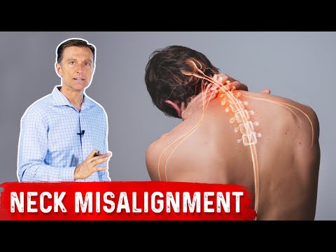 Chronic Neck Misalignment Does Not Come From the Neck