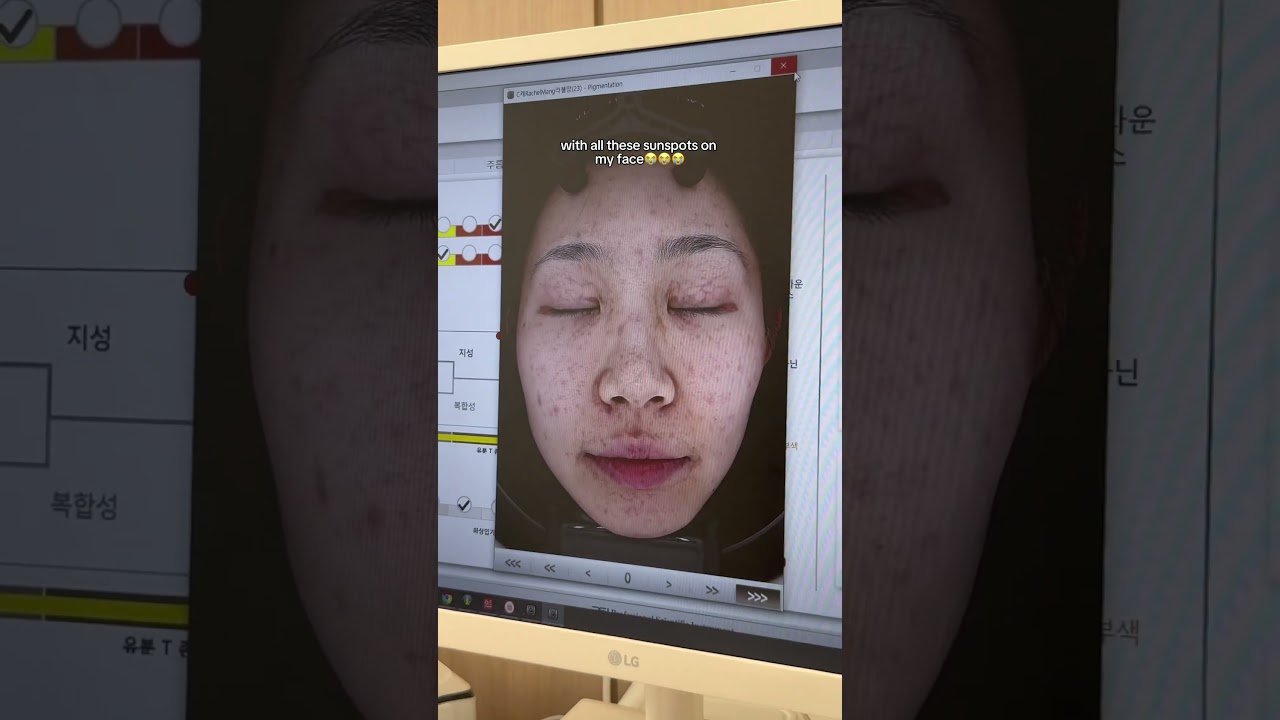 My First Skin Treatment Experience in Korea