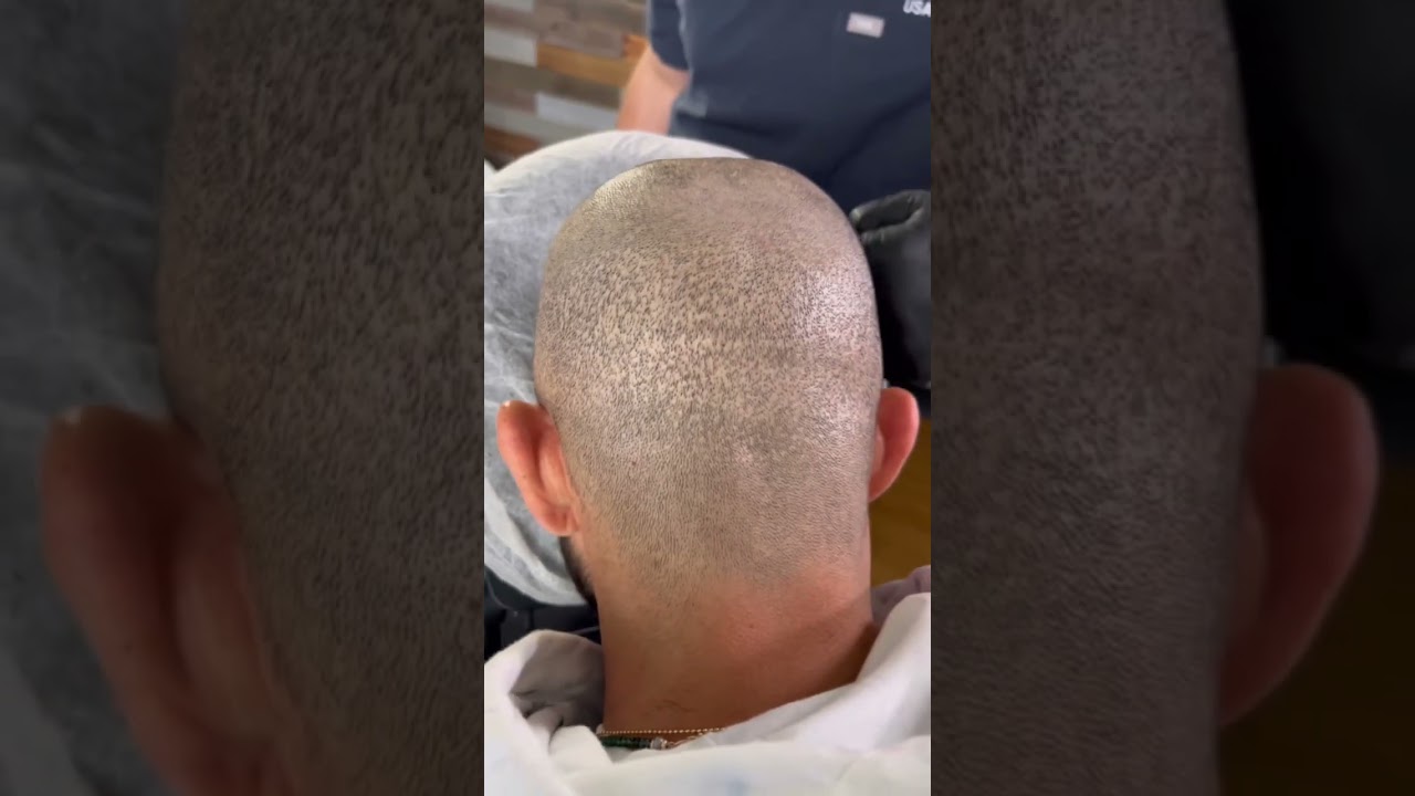 Fix Hair Transplant Scars with Micro Pigmentation ✨