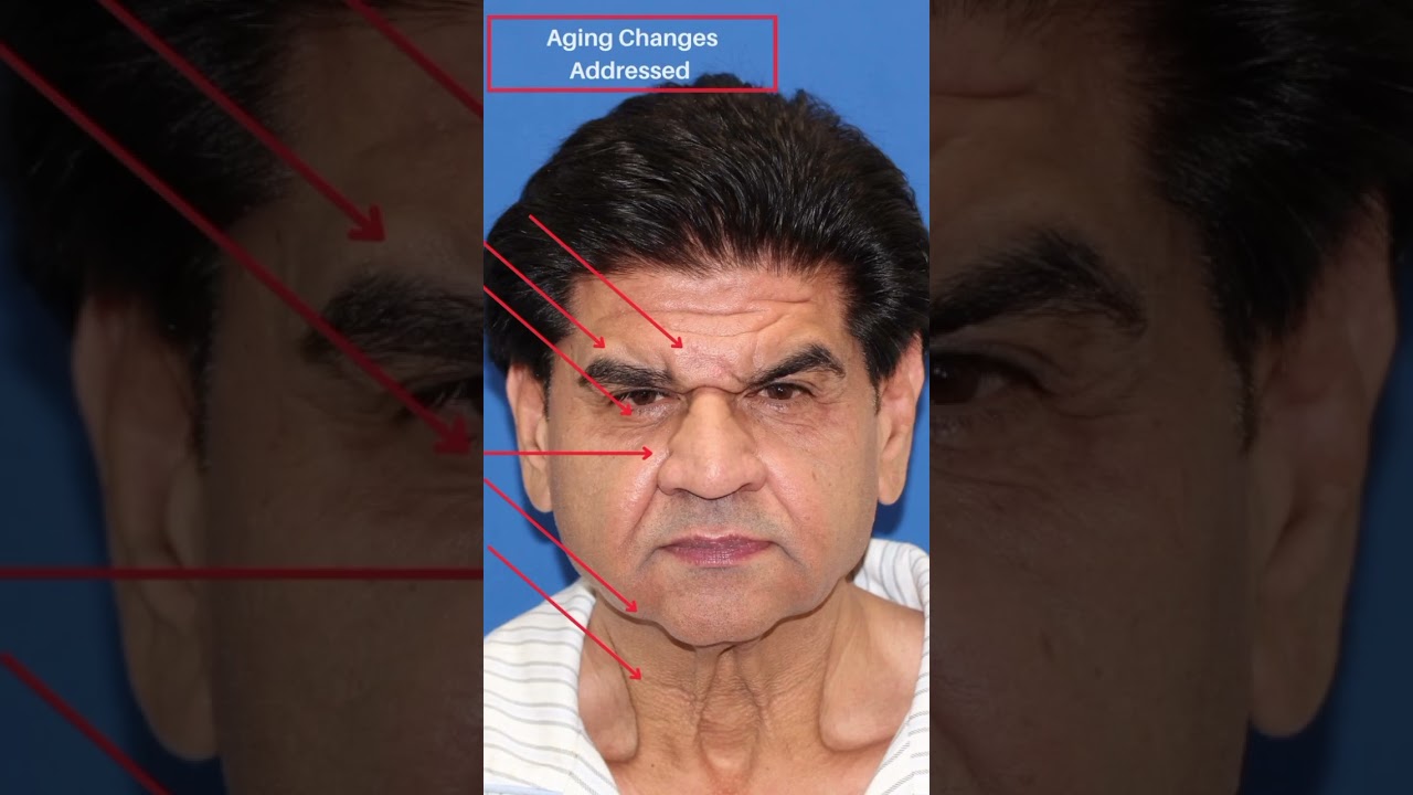 Man Looks 15 Years Younger After Facelift ✨