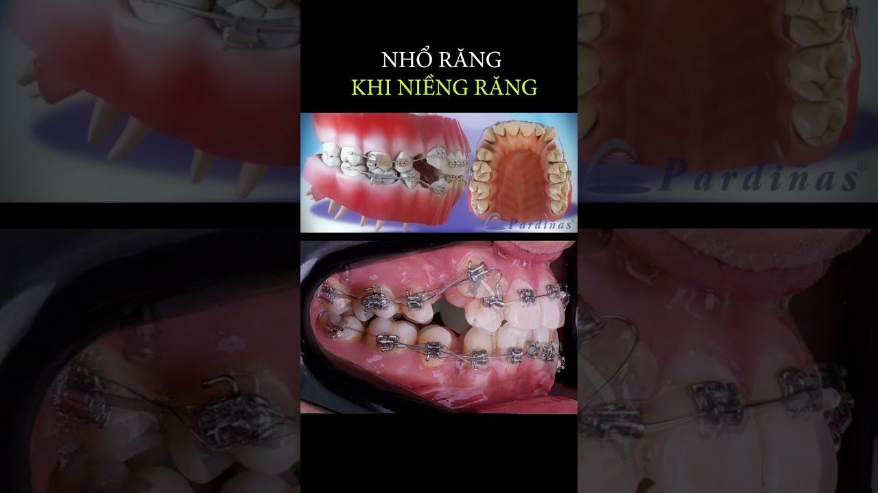 Tại sao phải nhổ răng khi niềng răng #braces #orthodontist #dental