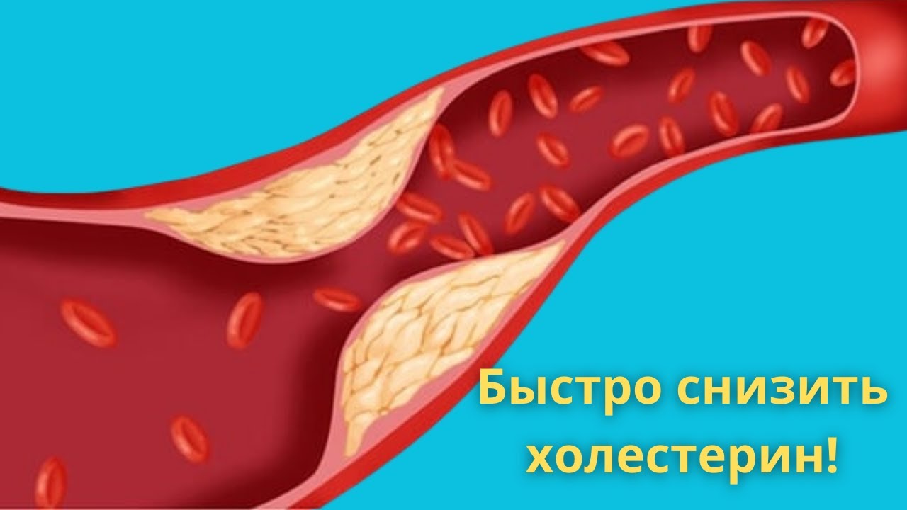Эффективные средства для чистки сосудов и снижения холестерина 🩺