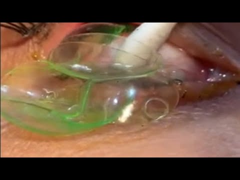 Doctor Extracts 23 Contact Lenses from Patient's Eye ποΈ