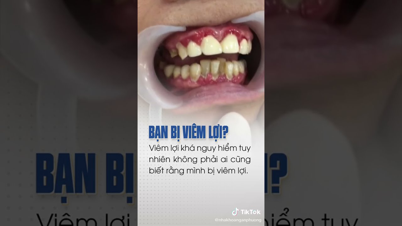 Dấu Hiệu Nhận Biết Viêm Lợi Răng 🦷