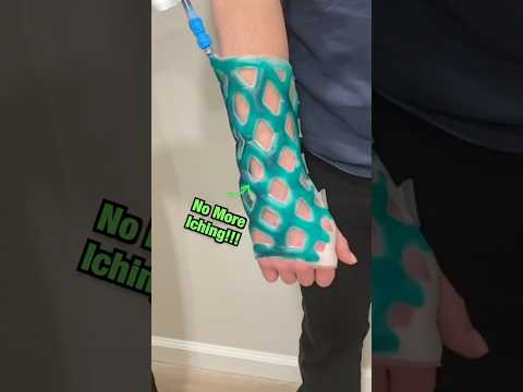 Why This New Cast is a Genius Invention 🤩