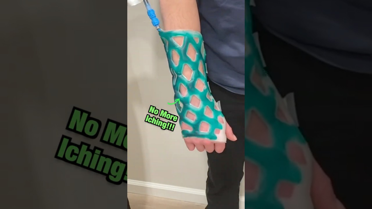 Revolutionary New Cast Tech: The Future of Bone Healing 🤩