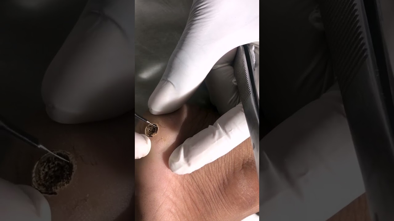 Safe & Effective Wart Removal at Skinaa Clinic