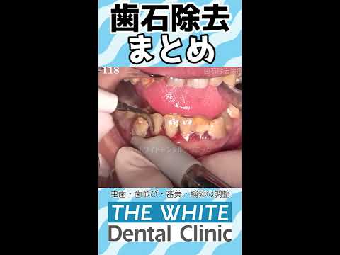 牡蠣化した歯石🦷【名場面集その1】Oyster-like tartar Collection of famous scenes 1#Shorts